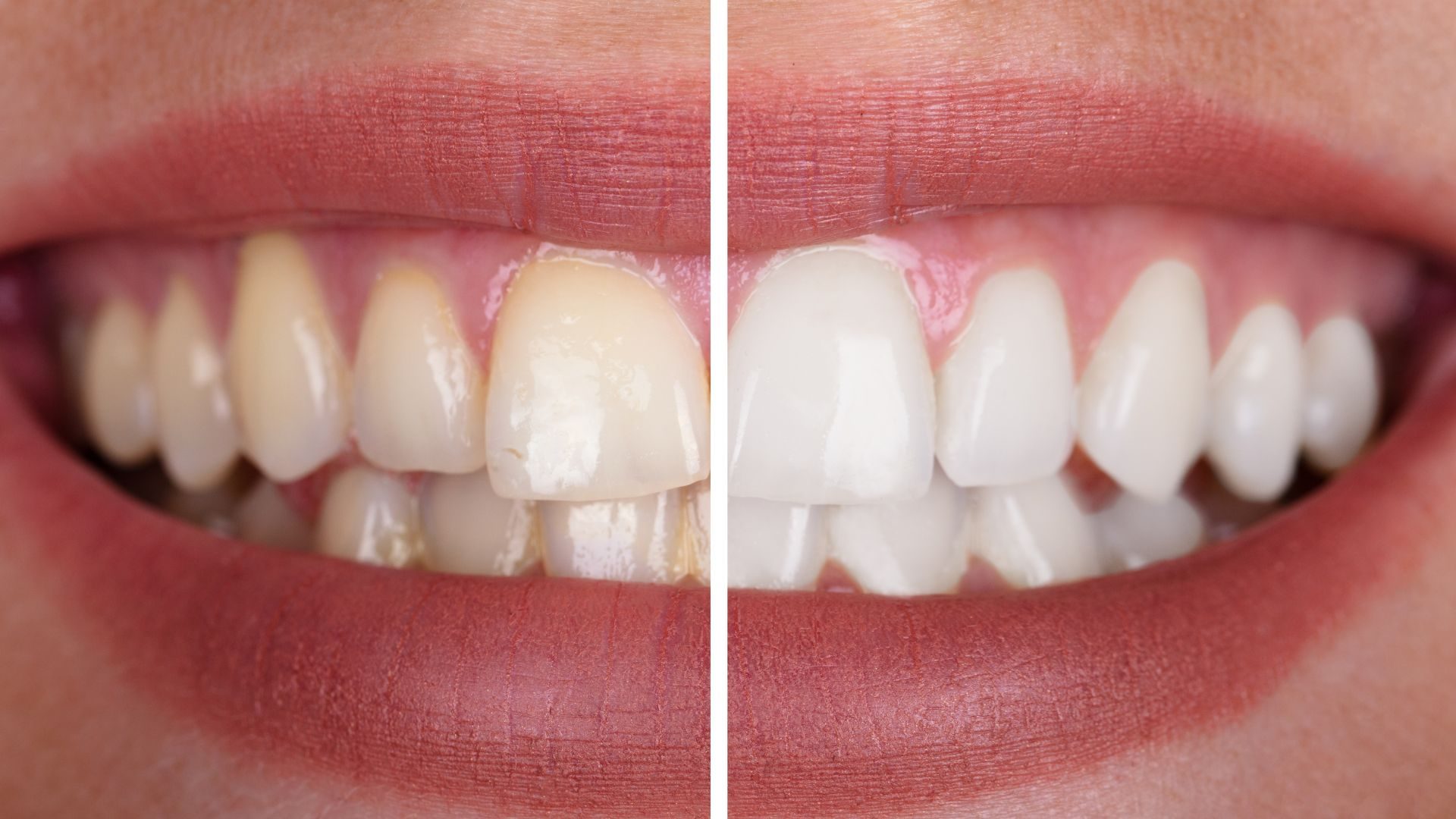 Bioesthetic Dentistry Symptom SEO Captures Patients Before Another Restoration Fails