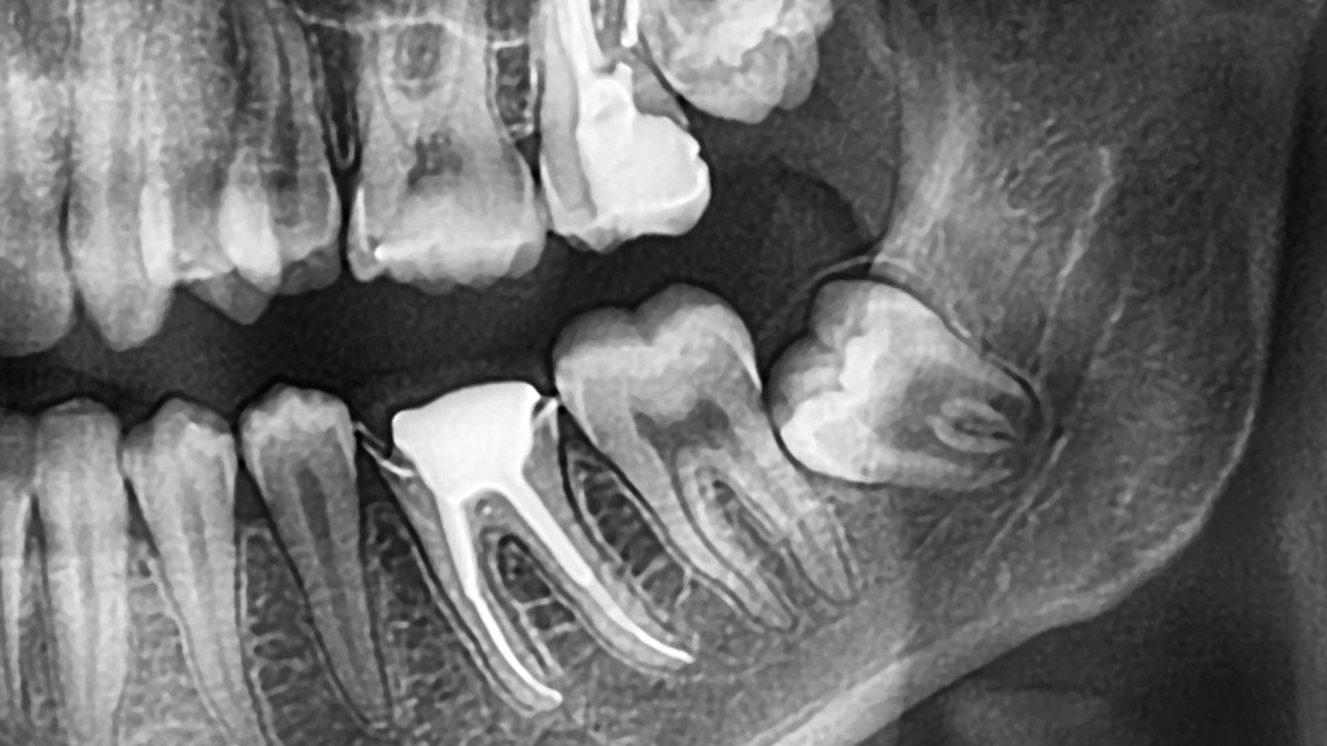 How Early Is Too Early for Patients to Consider Wisdom Tooth Removal Surgery? 