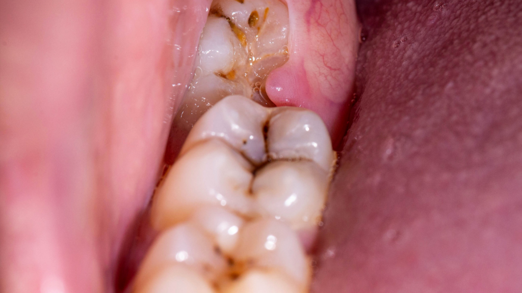 How Early Is Too Early for Patients to Consider Wisdom Tooth Removal Surgery 